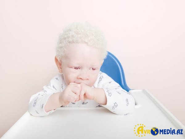 Albinos insanların özəllikləri nələrdir?