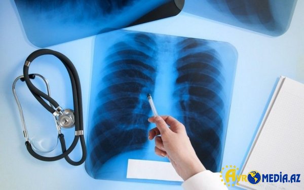 Kimlər vərəmə meyillidir? - Açıqlandı