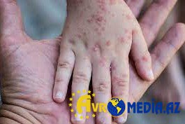 Qızılcaya yoluxma halı kəskin azalıb