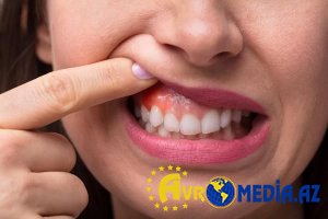 Diş ətiniz qanayırsa, bu vitamin çatışmır